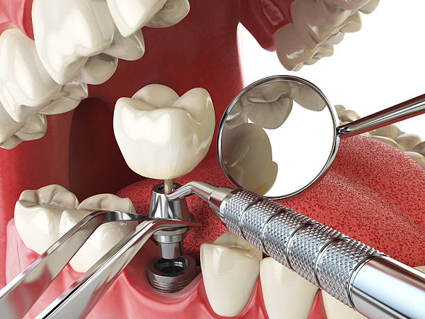 Best Emergency Tooth Extraction in Edburgh, IN